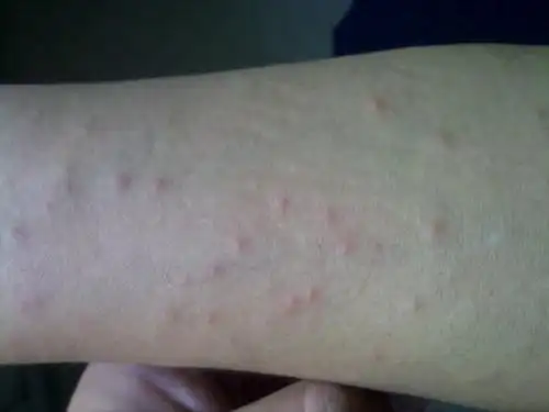 请问:双上肢起了皮疹,是湿疹吗?如图