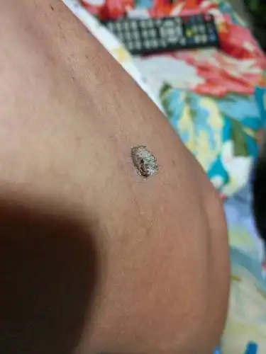 手臂上长了个肉疙瘩,不痛不痒的,肉疙瘩顶端像是一朵花一样,是怎么