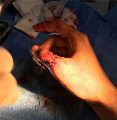 网上订餐 给差评用户被砍缝19针