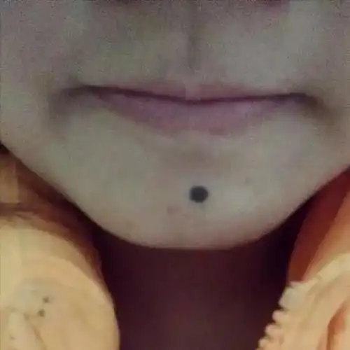 痣上长毛是好现象,不容易恶变(痣是黑色素瘤,良性的,在经常刺激到的