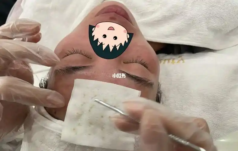 不清不知道毛孔里的脏东西#毛囊清洁术  #北海美甲美睫