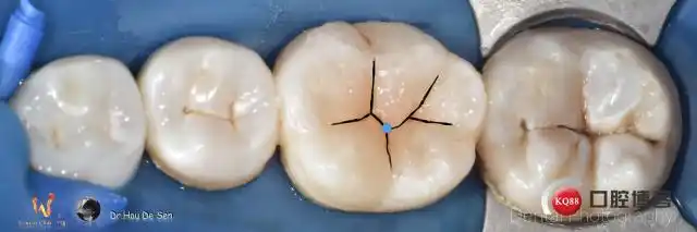 下颌第一磨牙形态逐步恢复-houdesen的博客-kq88口腔博客