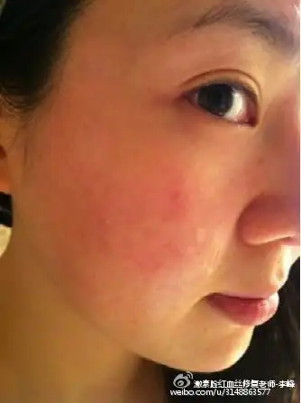 脸上的红血丝可以自愈吗