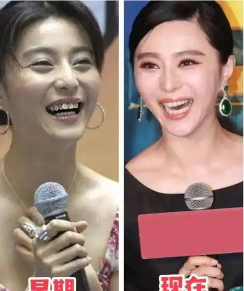 刘涛的牙掉了,吴宣仪合不上嘴,明星的白牙真的好看吗?_牙齿_林允_时候