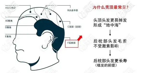 为了比较好的手术效果,医生建议他先种植脱发明显的头顶部位,发旋位置