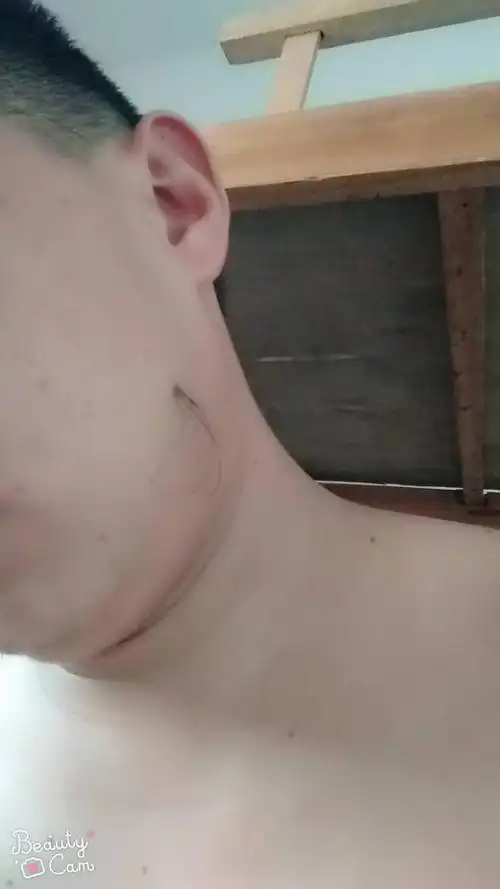 我这脸上的痣长毛要不要减掉,我姐说不要减,是有什么用吗