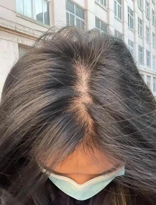 女生脱发怎么办? - 知乎