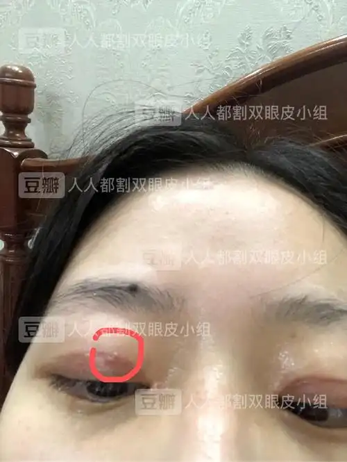是线结反应吗?眼皮上有一个小突起,露出线的颜色