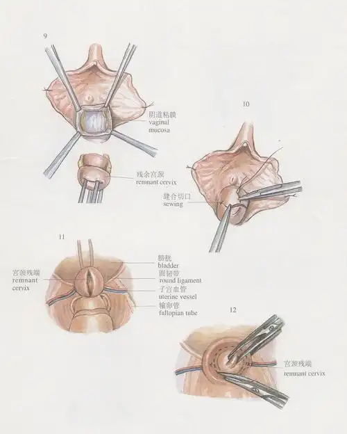 图122宫颈残断切除术