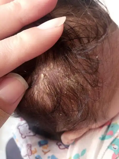 三个月小孩头上这是什么?