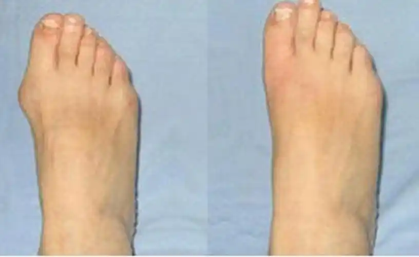 轻度拇外翻患者的术前术后对比图片