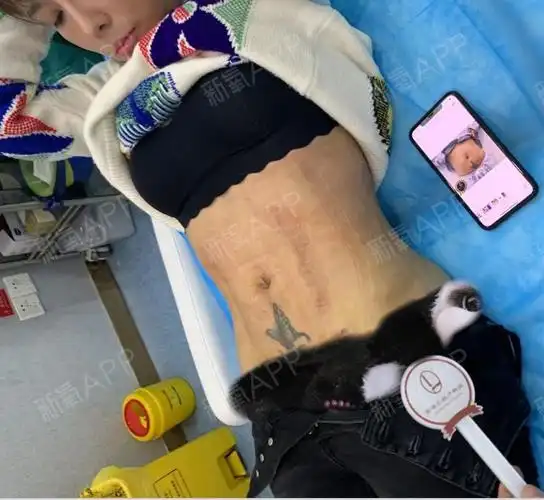 腰腹环吸,马甲线体雕术后恢复期打卡