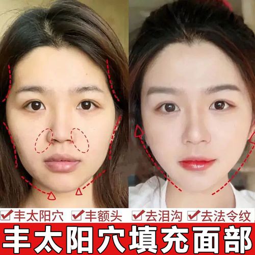 面部丰盈液丰太阳穴重组胶原蛋白饱满面部凹陷填充泪沟丰脸精华液