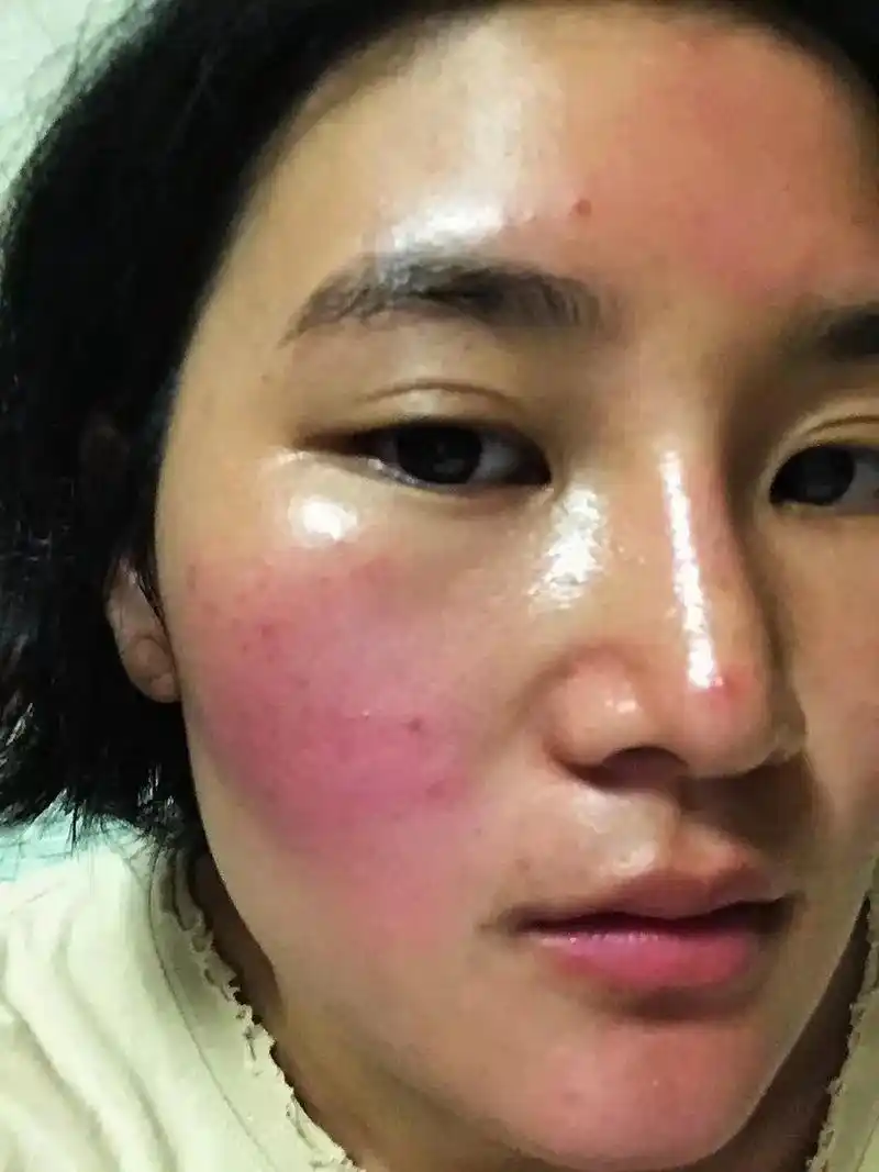 红烫肌怎么办,能好吗!妮妮的脸没调理好之前堪称"高原红",脸 - 抖音