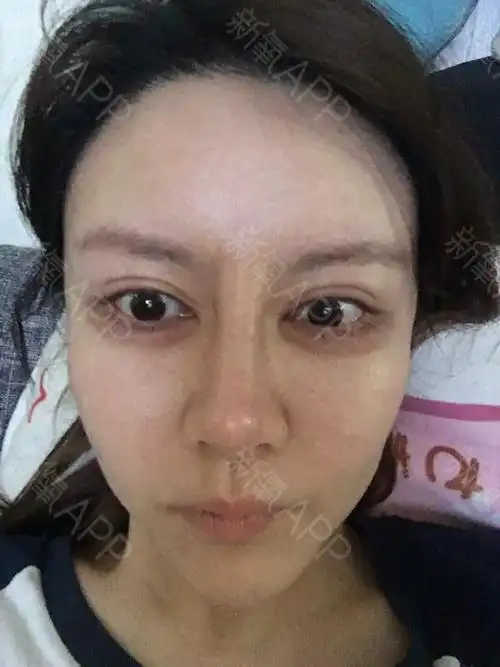 玻尿酸填充卧蚕