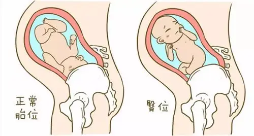 宝宝臀位端坐母腹安太助其华丽转身