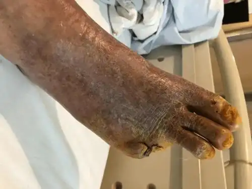 下手太狠萧山一大伯竟把自己的脚趾切了