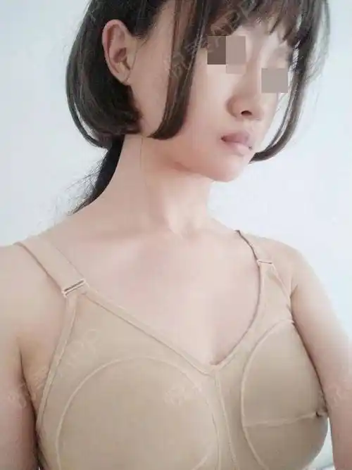 吸脂瘦大腿术后30天_自体脂肪面部填充术后30天_自体脂肪隆胸术后30天