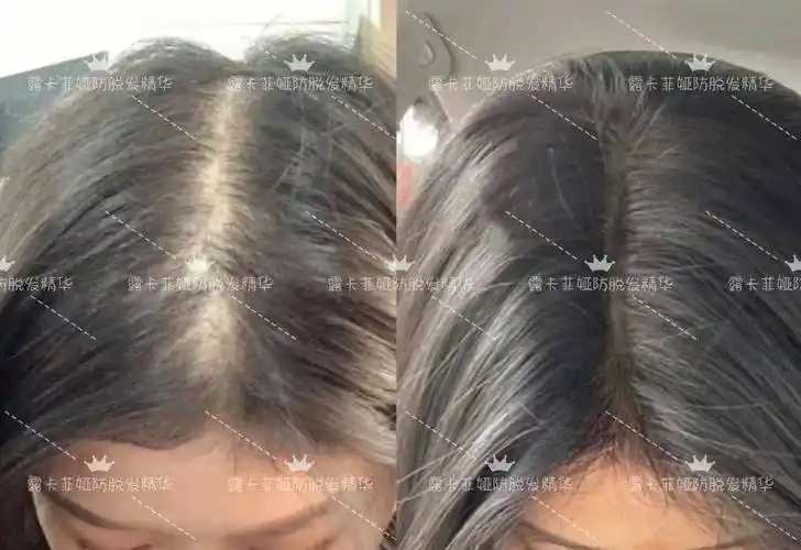 平价防脱发生发增发密发哪个牌子好?泼天发量密码分享_头发_周期_头皮