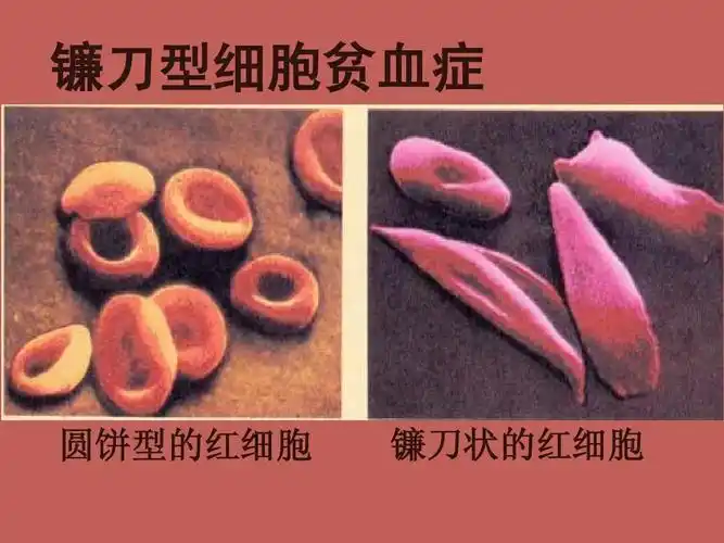 镰刀型细胞贫血症 圆饼型的红细胞 镰刀状的红细胞