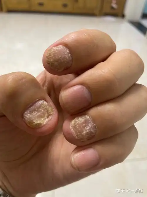 指甲型银屑病,银屑病甲的治疗之路 - 知乎