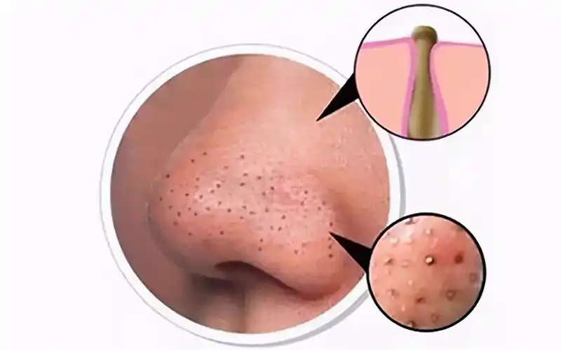 毛孔严重堵塞怎么办(毛孔粗大堵塞怎么解决)-情感知识库-动动脑