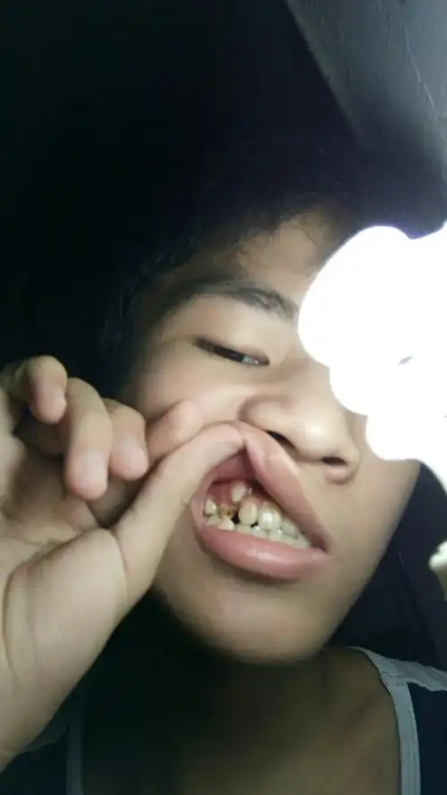 牙齿长在牙龈上