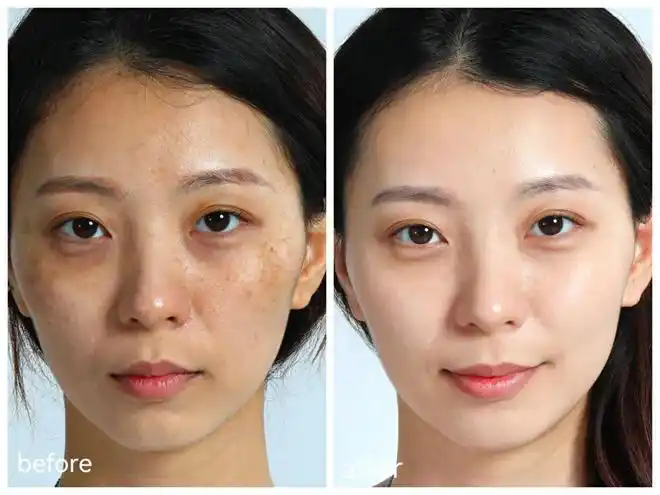 先让大家看看我祛斑前后的对比照,区别是不是非常大?