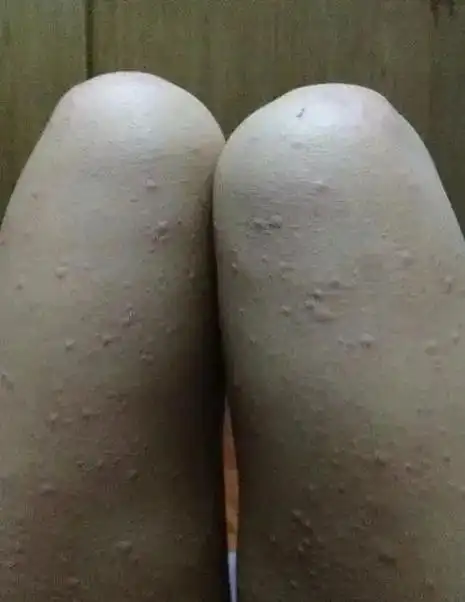 没有经历过慢性荨麻疹的人,真的体会不到它有多折磨人,就像原野 - 抖