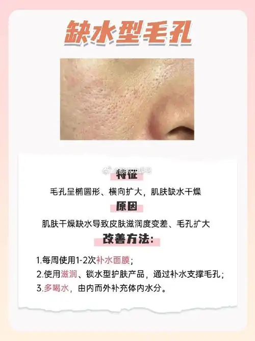 不迷糊了731分钟简单判断毛孔粗大原因90