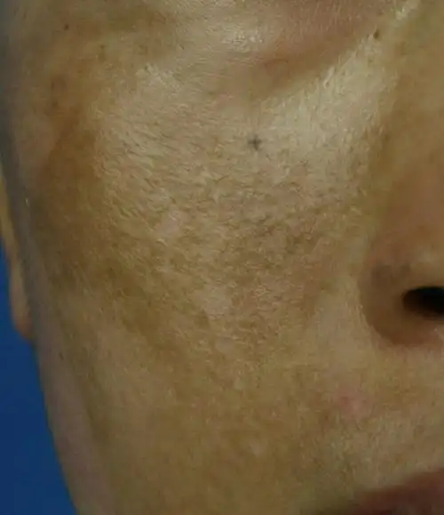 黄褐斑该怎么治疗???请看这里…… - 美篇