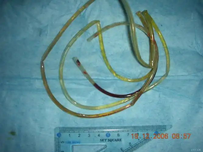 【共享】罕见尿道异物(有图有真相)