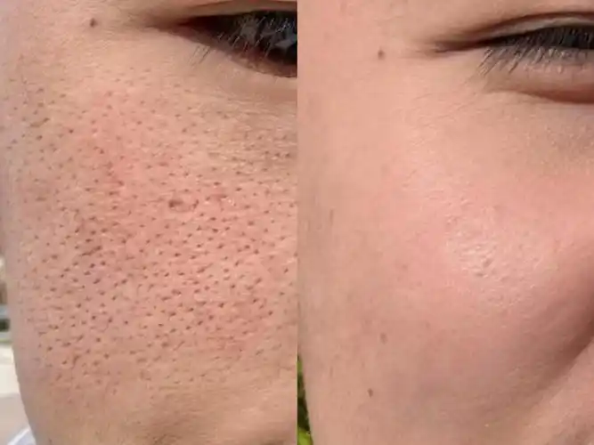 务必要先把堵塞在毛孔里的油脂,脏东西给清理出来,不然做再多都是徒劳