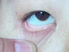 活动后头晕乏力气短哈医大四院血液科专家提醒警惕贫血