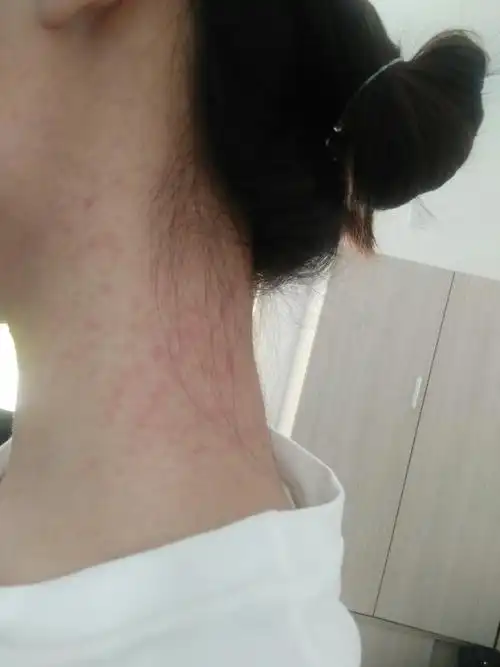 脖子满满红色小疙瘩都红了很痒.