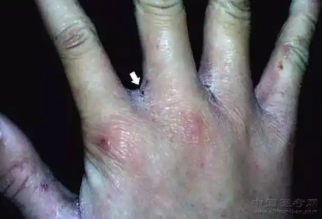 129.手部疥疮皮疹(指间丘疹和结痂)