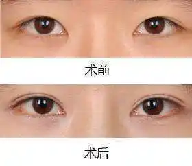 q3:请问我单眼皮好还是双眼皮呢?