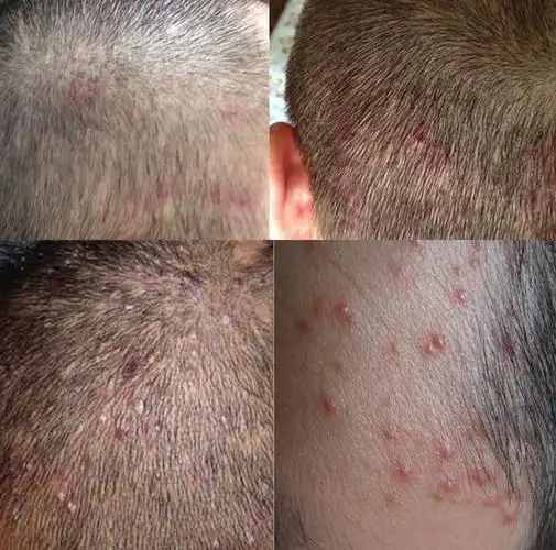 毛囊肤硫磺去头螨虫洗发水藓痒头皮痘痘长痘红点洗发水