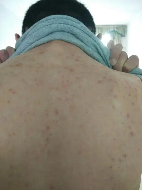 我才14岁,怎么背上长了这么多痘痘?
