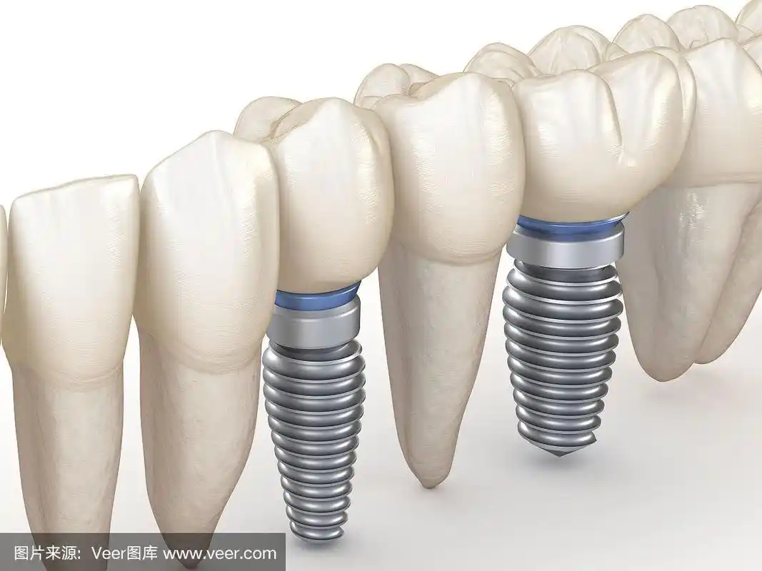 种植牙整齐.人类牙齿的3d插图概念.