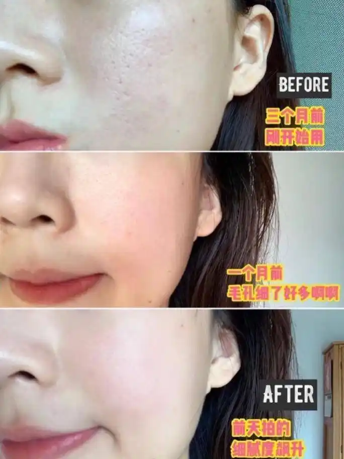 如何收缩毛孔的医美干货"毛孔粗大"的你选对了么