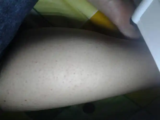 分享到:  2014-04-01 23:47 提问者采纳  热心网友 这是毛囊炎