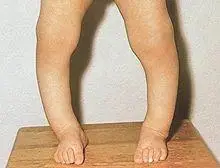 佝偻病的治疗方法_病因_饮食_检查_佝偻病症状-求医网