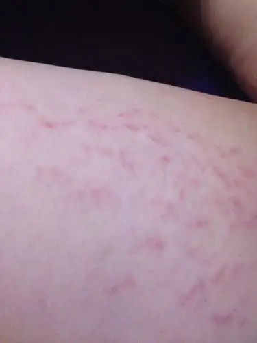 本人骨折之后,右伤腿无法走路,左腿在家蹦着走,最近发现左腿大腿内侧