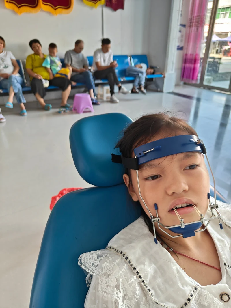 带上前方牵引器,很快牙齿不齐就完美牵好,矫正牙齿不齐,我们更专业139