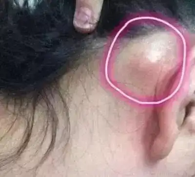 耳朵里面长了个硬包耳后淋巴癌早期症状图片