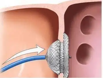 1,创伤小:穿刺部位小伤口,无需缝合,无痛苦,无毁损性操作.