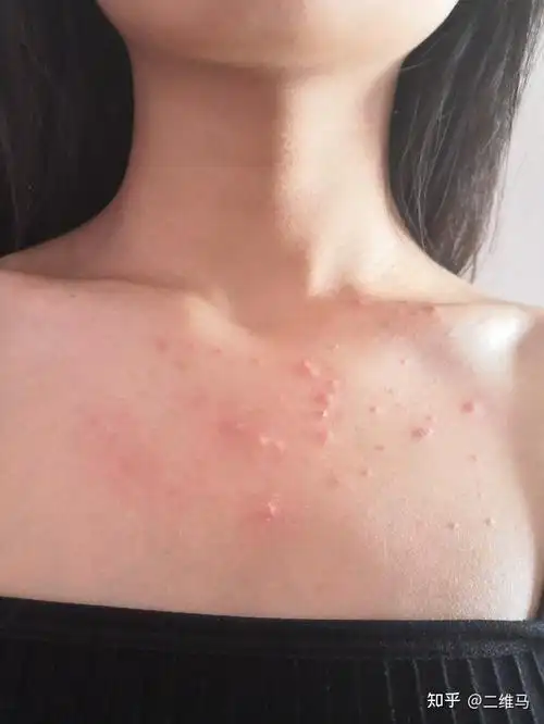 胸前长这样的痘痘而且越来越严重是怎么回事啊怎么解决