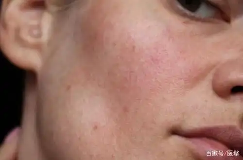 过度水合导致皮肤敏感