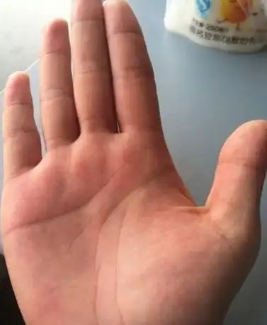 太阳丘隆起之人,未来可获财富与声名,智慧线分叉,有两条,代表理智